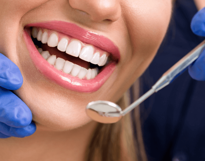 teeth whitening